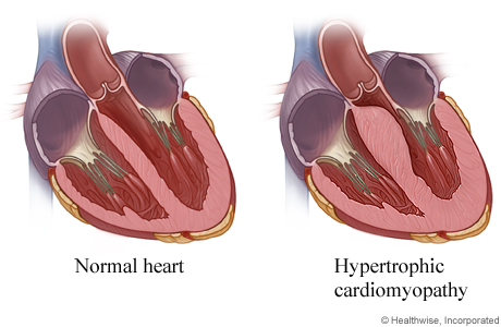 HVI Hypertrophic